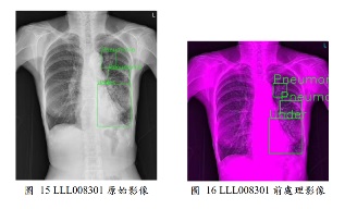 Covid19 Detection